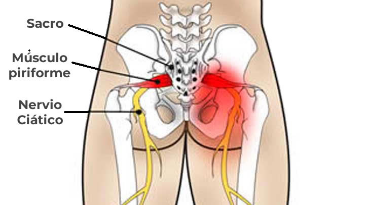 Dolor del Nervio Ciático